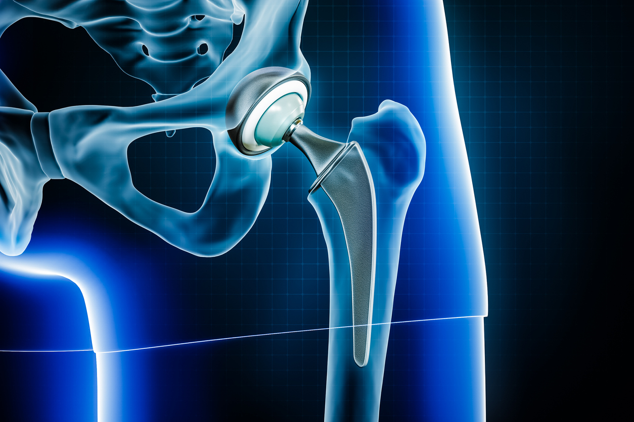 Hip Surgery in South Carolina | Palmetto Bone & Joint